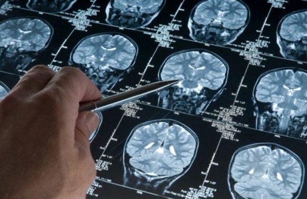 اكتشاف منطقة في الدماغ تستجيب للعلاج الوهمي 
