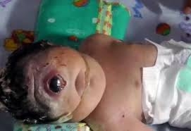  إندونيسيا.. ولادة طفلة بعين واحدة!