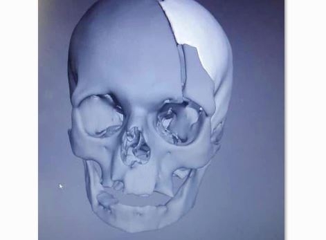  لأول مرة في سورية… عمل جراحي لتعويض قسم مفقود بعظم الجمجمة بتقنية طابعة ثلاثية الأبعاد