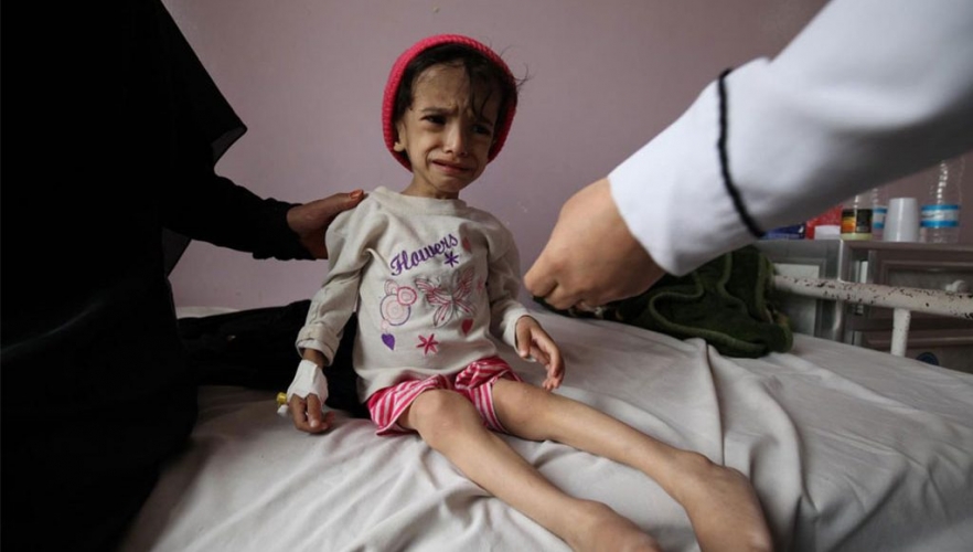 400 ألف طفل يمني يعانون من سوء التغذية الحاد الوخيم