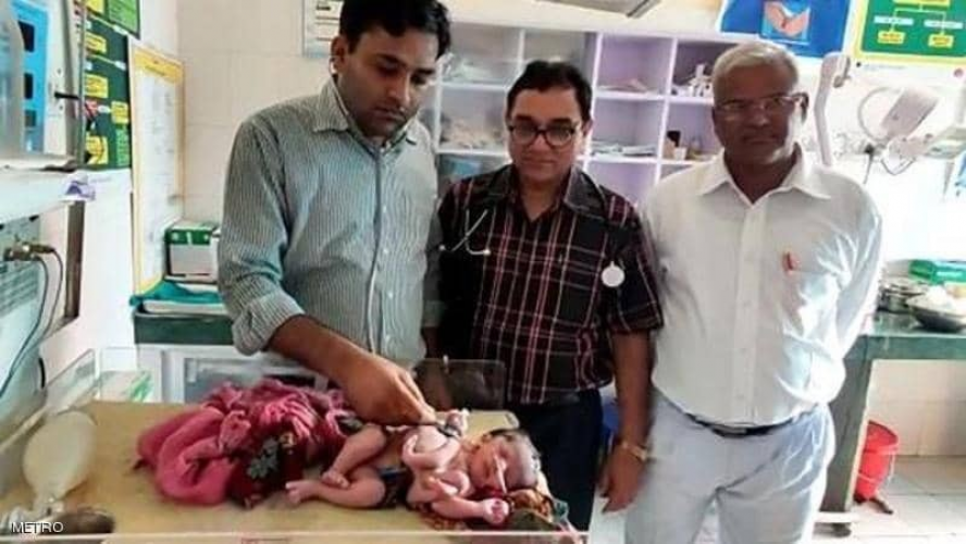  صدمة طبية.. ولادة طفلة بأربع أرجل و3 أياد