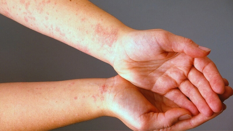 كيف يتم الوقاية من الاصابة بفطريات الجلد في فصل الصيف؟
