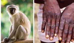 الصحة العالمية تعلن وفاة 58 شخصا بجدري القرود في الكونغو الديمقراطية   