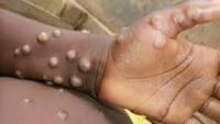 السودان يعلن تسجيل أول إصابة مؤكدة بجدري القردة في البلاد