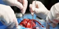 إيران تجري اول جراحة ناجحة بالعالم لإصلاح صمام القلب ثلاثي الشرف