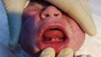 حالة طبية نادرة..ولادة طفل عراقي بأسنان